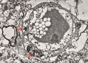 M,71y. | CADASIL accompanied with Alzheimer disease - brain vessel - arrows: granular osmiophilic material (GOM) between basement membranes M,71y. | CADASIL accompanied with Alzheimer disease - brain vessel - arrows: granular osmiophilic material (GOM) between basement membranes